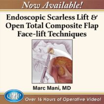Endoscopic Scarless Lift Open Total Composite Flap Face lift Techniques